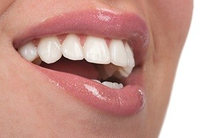 Closeup of smile after fluoride treatment