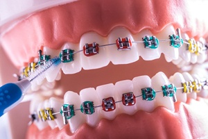 Close-up of colorful traditional braces on dental model