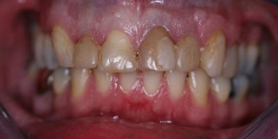 Closeup of Michael's severely decayed and discolored teeth before smile makeover