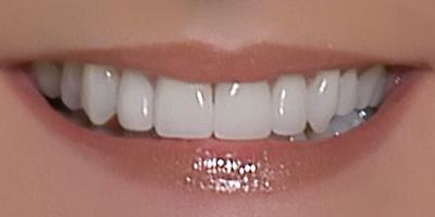 Closeup of Shelly's gorgeous smile after complete smile makeover
