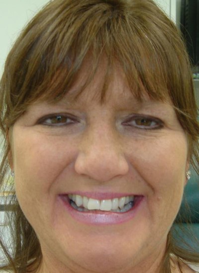 Shelly sharing neglected smile before complete smile makeover