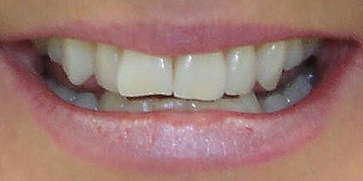 Closeup of Shelly's neglected smile before complete smile makeover