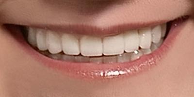Closeup of Stella's perfected smile after orthodontics and fixed bridges