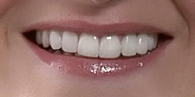 Closeup Amy's properly aligned smile after porcelain veneers and fixed bridge treatment