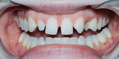 Closeup Amy's unevenly spaced teeth before porcelain veneers and fixed bridge treatment