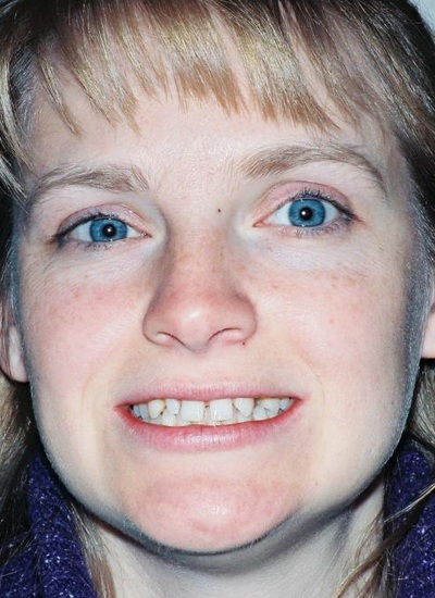 Amy sharing unevenly spaced smile before porcelain veneers and fixed bridge treatment