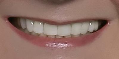 Closeup of Brenda's healthy beautiful smile after porcelain veneers