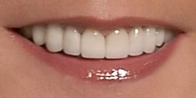 Closeup of Cynthia's perfected smile after smile makeover