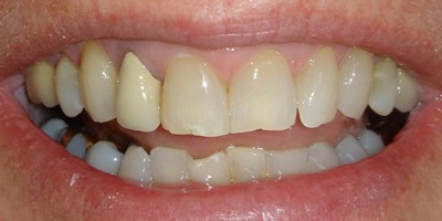 Closeup of Cynthia's worn and imperfect smile before smile makeover