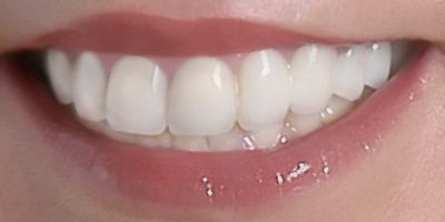 Closeup of Dawn's smile after dental crown and porcelain veneer treatment