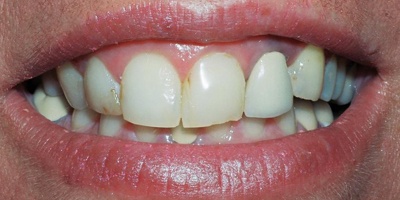 Closeup of Dawn's smile before dental crown and porcelain veneer treatment