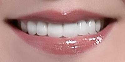 Closeup of Diana's beautiful smile after full mouth reconstruction