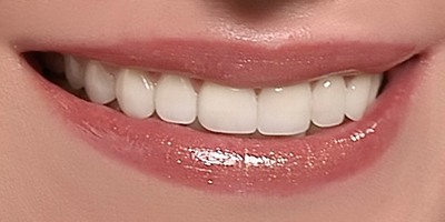 Closeup of Jessica's flawless smile after porcelain veneers