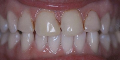 Closeup of Jessica's yellowed and imperfect teeth before porcelain veneers