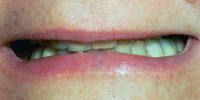 Closeup of Joanne's severely worn teeth before complete smile makeover and T M J therapy