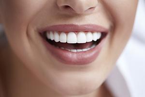 Closeup of smile after teeth whitening