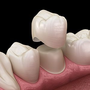 Animated dental crown placement