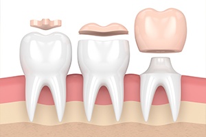 Animated porcelain dental crown placement process