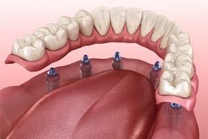 Illustration of implant dentures for lower dental arch