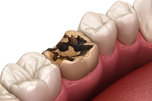 Illustration of damaged tooth that may need to be extracted