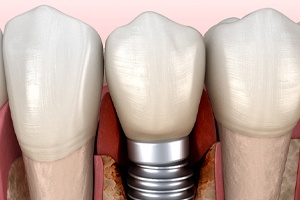 Illustration of peri-implantitis, most common cause of dental implant failure
