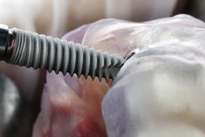 Close-up of dental implant being inserted into dental model