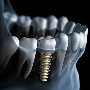 Animated smile with dental implant supported dental crown placement