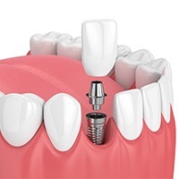 Animated dental implant supported dental crown placement