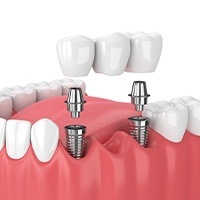 Animated dental implant supported fixed bridge placement