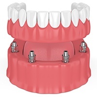 Animated dental implant supported denture placement