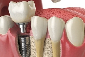 Animated dental implant supported dental crown placement