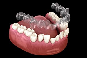 Illustration of Invisalign being used to correct crooked teeth