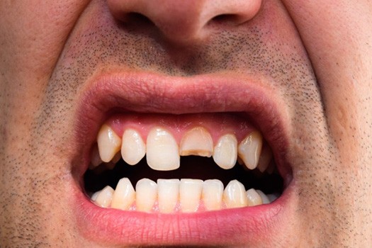 Man revealing broken tooth