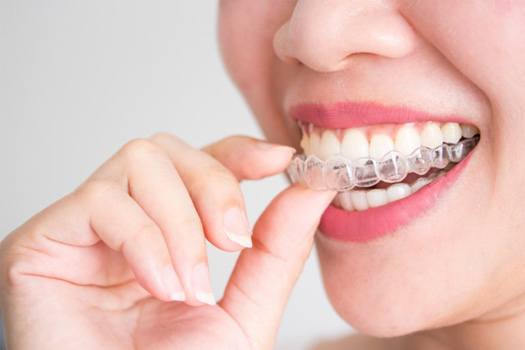 Woman inserting a top Invisalign tray