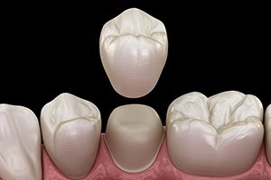 Animated dental crown placement