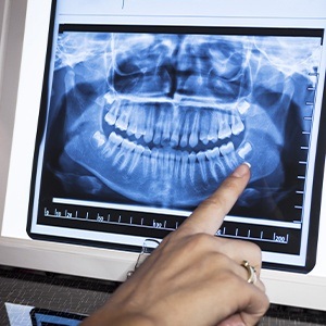 Digital dental x-rays on chairside computer
