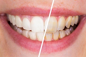 Smile before and after teeth whitening