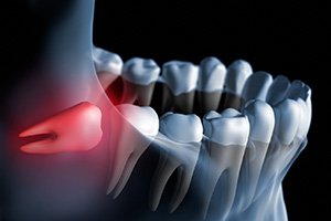 Illustration showing impacted wisdom tooth in lower jaw