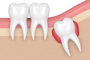 Illustration of cyst around wisdom tooth