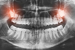 X-ray of smile with impacted wisdom teeth prior to extractions