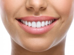 Woman's perfect teeth after veneers or Invisalign in Belmont