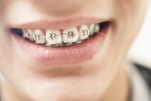 Close-up of traditional braces in Belmont on patient’s teeth