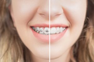 Close-up of smiling woman, transitioning to life after braces