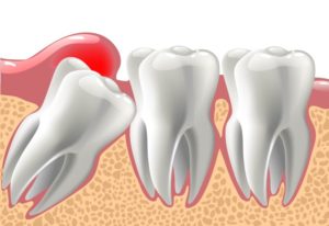 Illustration of impacted wisdom tooth